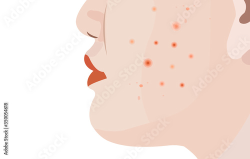 Pimple on woman face skin on white background vector