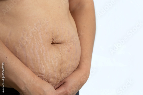 Mexican woman belly with stretch marks close up on white background