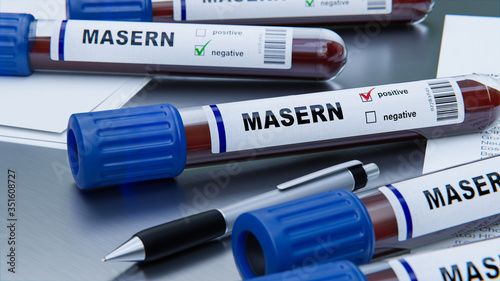 positiver Bluttest Masern Virus im Labor, Nachweis von Antikörper