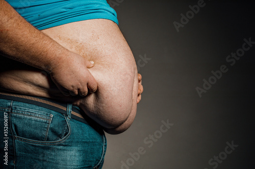 Overweight of a person's body with hands touching the abdomen. The concept of obesity