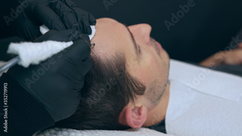 High quality close-up of a man laying on a couch during the esthetician hair treatment. Male tricopigmentation service. Scalp micropigmentation treatment. Trichopigmentation procedure.