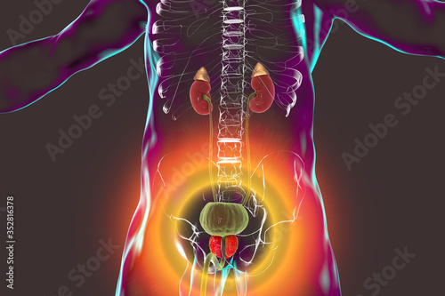 Benign prostatic hyperplasia