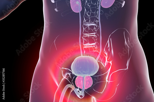 Benign prostatic hyperplasia