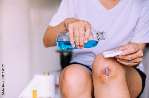 Woman pouring alcohol into a cotton for cleaning bleeding wound on knee,Scab becomes Infected