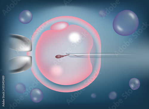 Intracytoplasmic sperm injection, ICSI, as part of IVF process