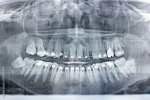 X-ray photograph of human teeth with a braces system. Retarded Wisdom Tooth. Film noise effect