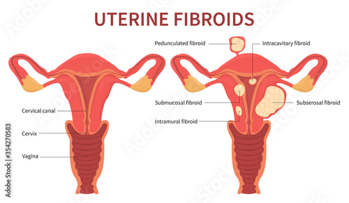 Isolated flat vector illustration of uterine fibroids, myoma, uterine leiomyomas on white background. Reproductive system picture displays pedunculated, intracavitary, submucosal, subserosal.