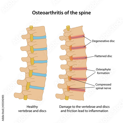 Osteoarthritis of the spine with main description. Healthy spine and spine with osteoarthritis in lateral view are isolated on white background. Vector illustration in flat style
