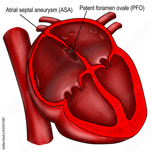 The patent foramen ovale and atrial septal aneurysm are the structural heart condition which cause the cerebral embolism and ischemic stroke.