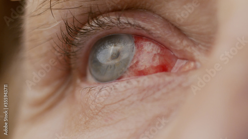 close up. woman eye with chemical burns of the cornea. burst capillaries, cataract surgery.