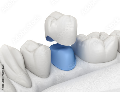 Porcelain crown placement over premolar tooth. Medically accurate 3D illustration
