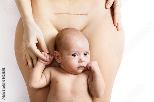 Newborn baby and his mother with a scar after C-Section on her belly