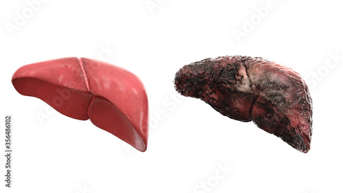 healthy liver and disease liver on white isolate. Autopsy medical concept. Cancer and smoking problem. 3d rendering