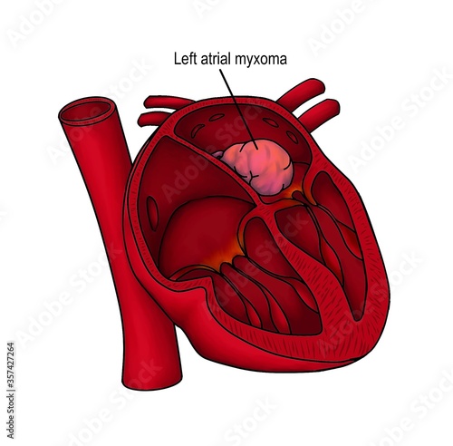 Atrial myxoma is the tumor of humna's heart which is the one of cardioembolic source of embolization.