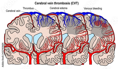 Arterial and venous circulation of human's brain and the cerebral vien thrombosis. 