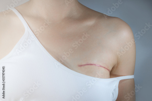 Breast cancer surgery scars by partial mastectomy. Woman shows scar from mastectomy of operation of her breast cancer. She can wear a tube top or tube dress and strapless with confident. 