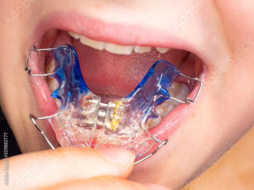 Patient photo of teeth with orthodontic braces.