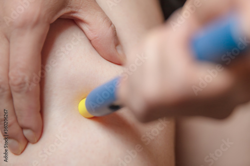 Woman using a pre-filled syringe or pen injection into the femoral area, closeup