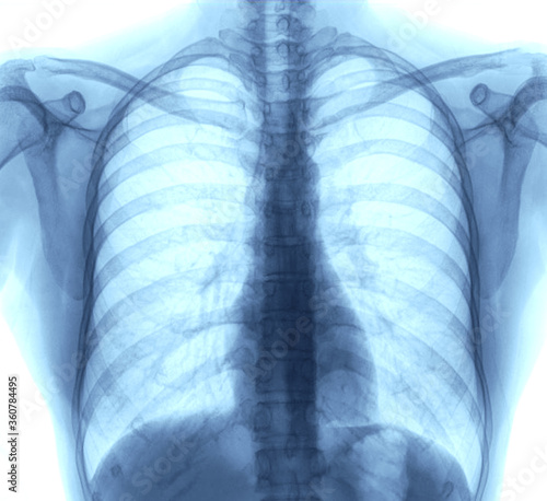 Lung Chest x-ray images