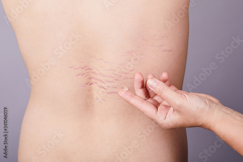 Close up view of the hand holding a drop of transparent gel on the young pearson's back with striae distensae (striae rubrae) background. The concept of impaired skin elasticity during puberty