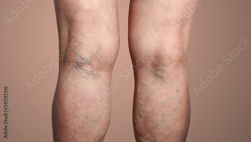 The varicose veins on a legs of woman