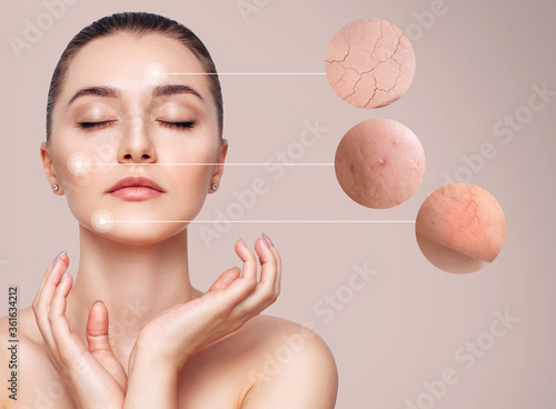Magnifying circles shows skin problems - couperose and acne on skin of young woman. Over beige background.