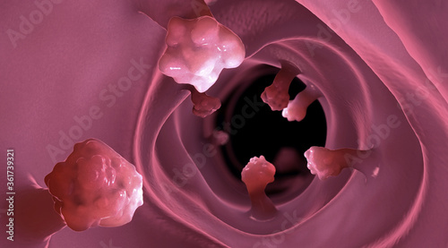 Close-up view of intestinal polyps and diseased intestinal tissue that can cause cancer - 3d illustration