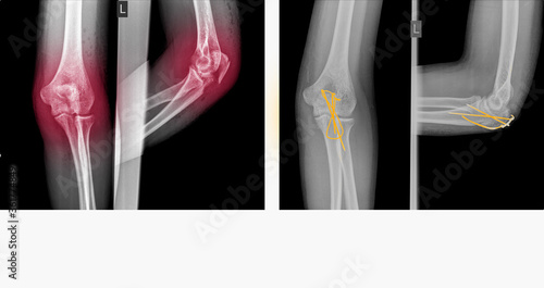 X-ray elbow showing fracture (proximal Ulna or Olecranon fracture) treated by surgery with tension band wiring fixation(TBW). Highlight on medical instrument.Medical healthcare concept.