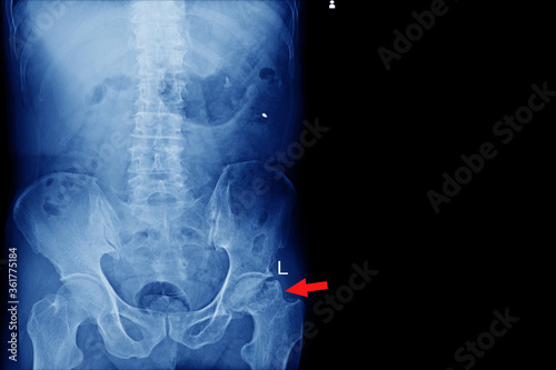 X-ray lumbo-sacral spine and pelvis No fracture, dislocation , bony destruction Normal joint space finding Aseptic necrosis.