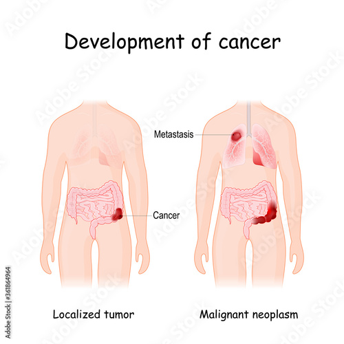 Cancer development. colon cancer and metastasis in lungs