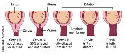 Cervical effacement and dilation during labor or delivery. Cervix changes from not effaced and dilated to fully effaced and totally dilated. Vector medical illustration