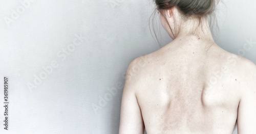 Young woman turned away to white wall, showing unhealthy back with scapular winging. Caucasian naked female with brown hair. Health care of spine, back and shoulder blades. Check up at hospital clinic