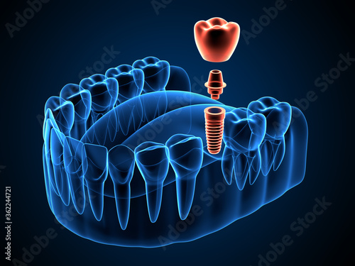 3d render of jaw x-ray with dental implant placement