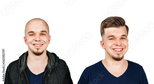 Man before and after transplant hair and alopecia. Isolated on white background