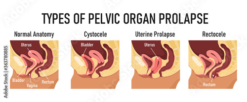 Types of pelvic organ prolapse - cystocele, uterine prolapse, rectocele
