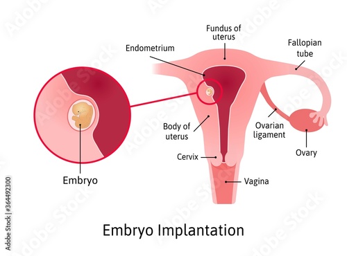 implantation. stage of pregnancy when embryo adheres to the wall of the uterus. Parts of uterus are marked with lines. Vector medical illustration.