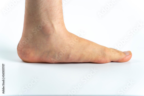 An advanced flat feet (pes planus or fallen arches) medical condition