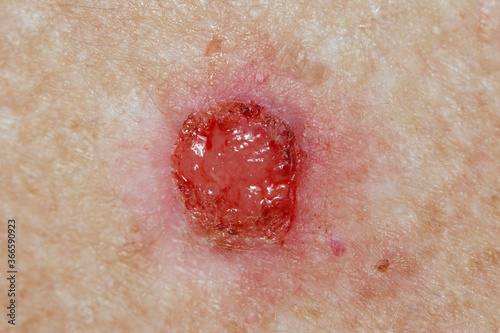 Basal Cell pre-treatment - sore open wound with constant weeping and bleeding. 