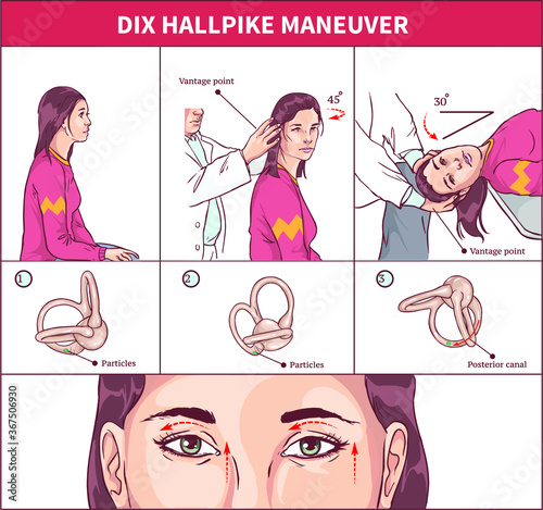 Dix Hallpike Maneuver Vector illustration