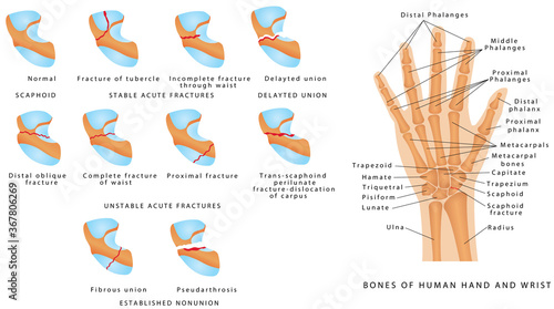 Wrist fracture (Scaphoid). Classification of scaphoid fractures. Break of the scaphoid bone in the wrist. Scaphoid bone fracture medical vector illustration on white background