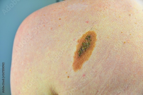 Macro shot of benign skin lesion. Proliferation of pigment derma cells, melanocytic pigmented naevus, naevocytic nevus. Mole or melanoma black color on man of skin lesion case