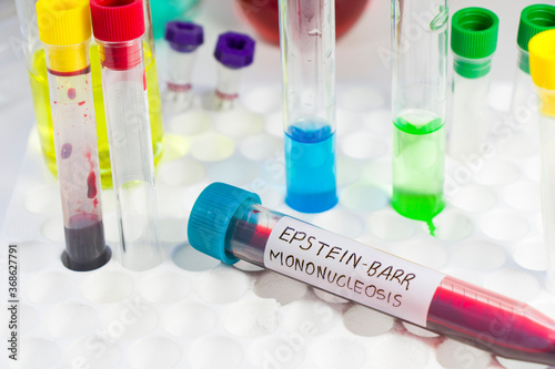 Mononucleosis and Epstein-barr virus blood test sample in lab