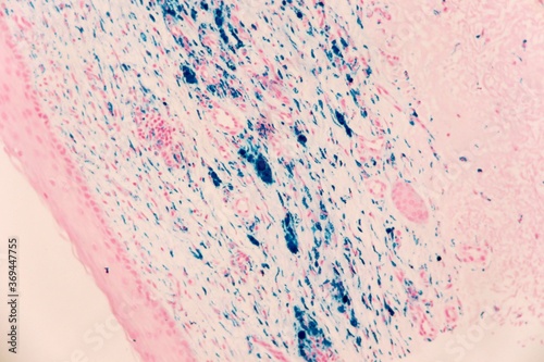 Skin with heavy iron deposits, called hemosiderin, which appear blue in this special stain. The skin is light pink. Microscopic view. The iron is residue from bleeding.