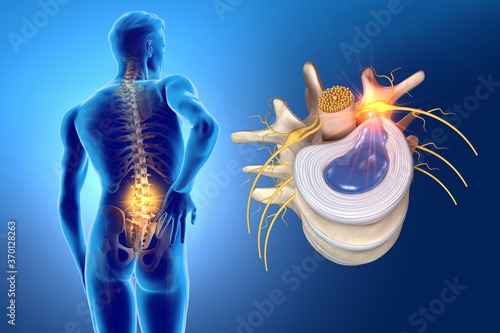 Lumbal vertebra with intervertebral disc and herniated nucleus pulposus