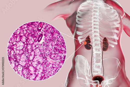 Kidney cancer, illustration and light micrograph