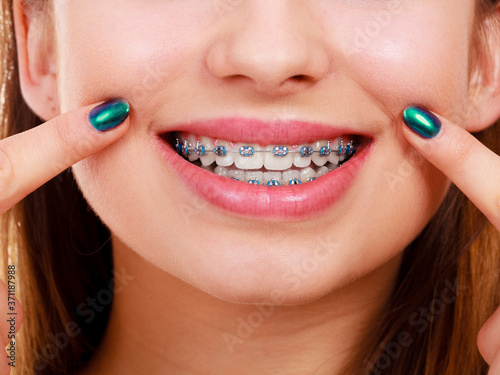 Woman showing her teeth with braces