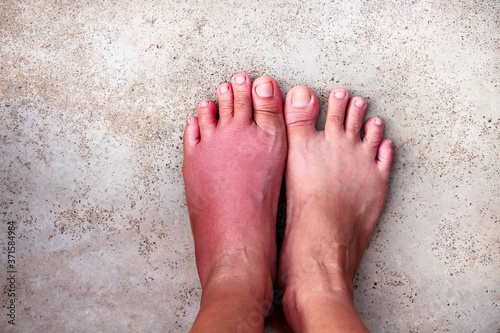 Woman left foot with red swelling from a bee sting on sister finger , inflammation allergy on skin old floor background top view