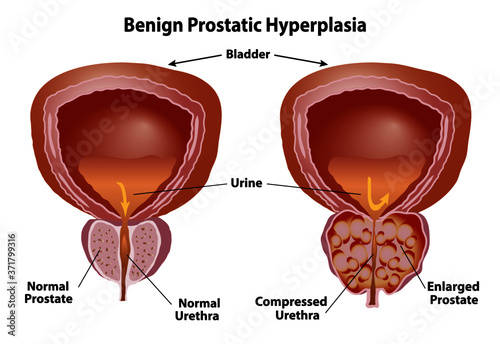 Prostate normal and enlarged. Benign prostatic hyperplasia with compressed urethra. Realistic style isolated on white background.