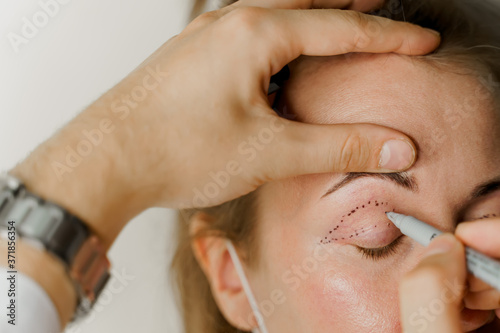 Blepharoplasty markup close-up on the face before the plastic surgery operation for modifying the eye region of the face in medical clinic. 2 doctors do plastic cosmetic operation