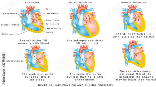 Heart failure. Heart Failure - Pumping and Filling Problems, Systolic Dysfunction, Diastolic Dysfunction. Heart failure or congestive heart failure. Diseases of the Heart. 